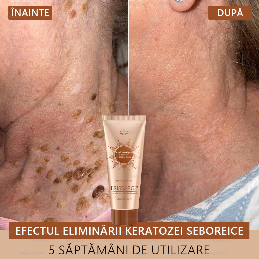 🔥FRISSARC™ masca facială pentru albire și îndepărtarea petelor –🍀Ingredientele naturale ajută la eliminarea eficientă și de durată a petelor pigmentare, petelor de vârstă, pistruilor și petelor solare.