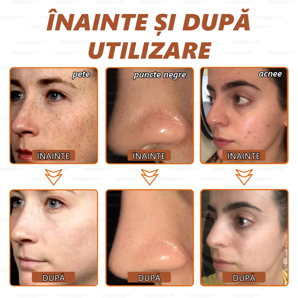 🎁 Felicitări! Te numeri printre primele 200 de comenzi! Profită acum de o reducere suplimentară de 50%! Acționează acum pentru a avea grijă de sănătatea pielii tale. Dacă ratezi această ocazie, la anul s-ar putea să nu mai existe! 🎁 Grăbește-te!