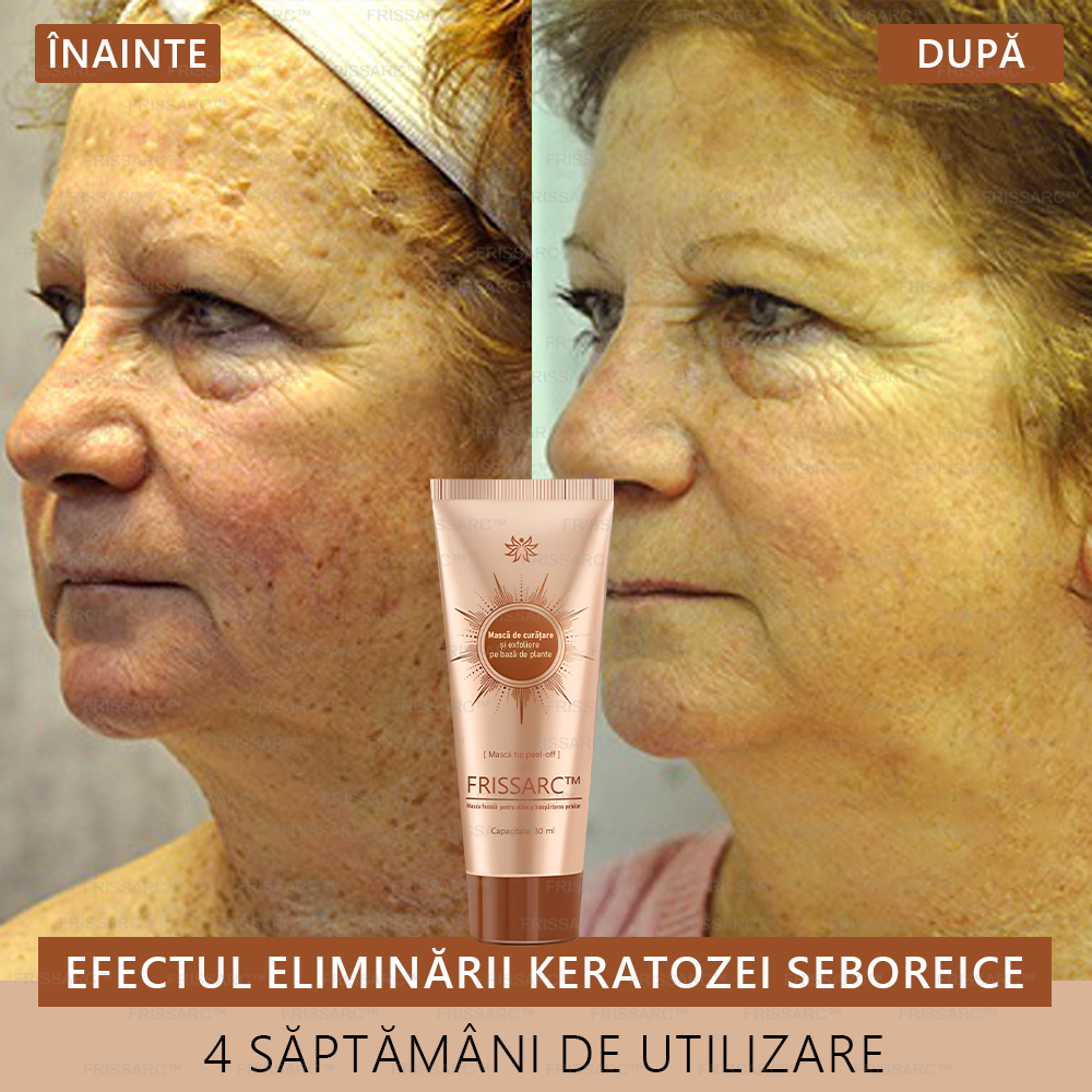 🎁 Felicitări! Te numeri printre primele 200 de comenzi! Profită acum de o reducere suplimentară de 50%! Acționează acum pentru a avea grijă de sănătatea pielii tale. Dacă ratezi această ocazie, la anul s-ar putea să nu mai existe! 🎁 Grăbește-te!